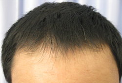 頭頂部の薄毛が目立つ20代男性の例の施術後イメージ