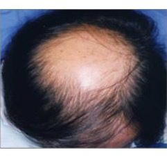 >O型（オーガタ）の薄毛の30代男性の例の施術前イメージ