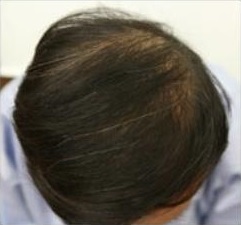 >O型（オーガタ）の薄毛の30代男性の例の施術後イメージ